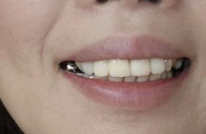銀歯を美しい白い歯へ - あびこ大人こども歯科クリニック